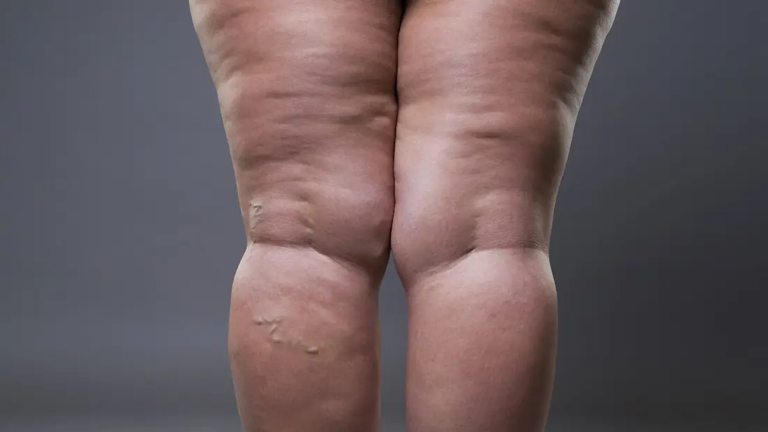 Sintomas do lipedema